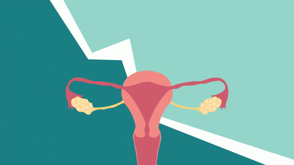 Is Your Pelvic Pain a Sign of Endometriosis?
